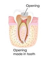 root canal Perth