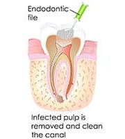 root canal treatment Perth