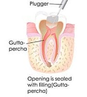 root canal therapy Perth