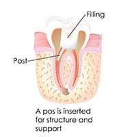 emergency dentist root canal