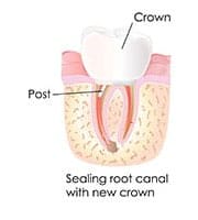 root canal emergency treatment