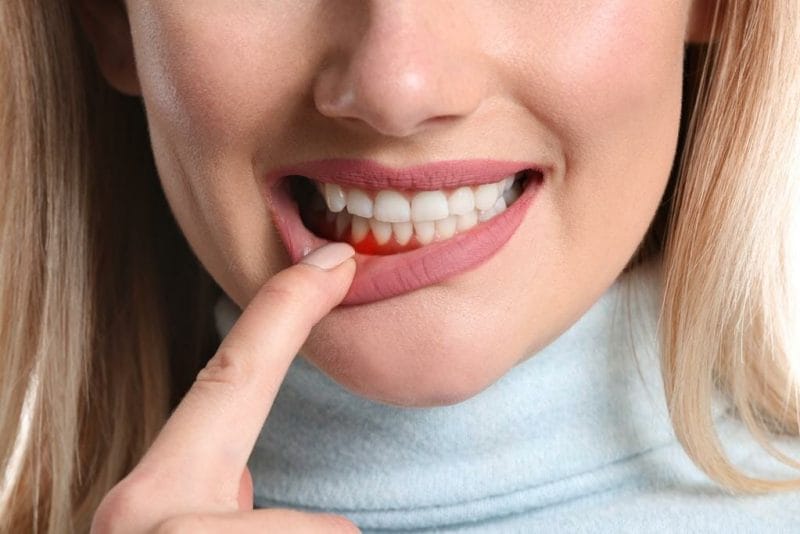 gum periodontal disease 