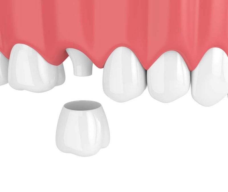 Perth dental crowns