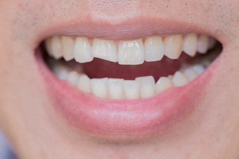 How to fix chipped tooth