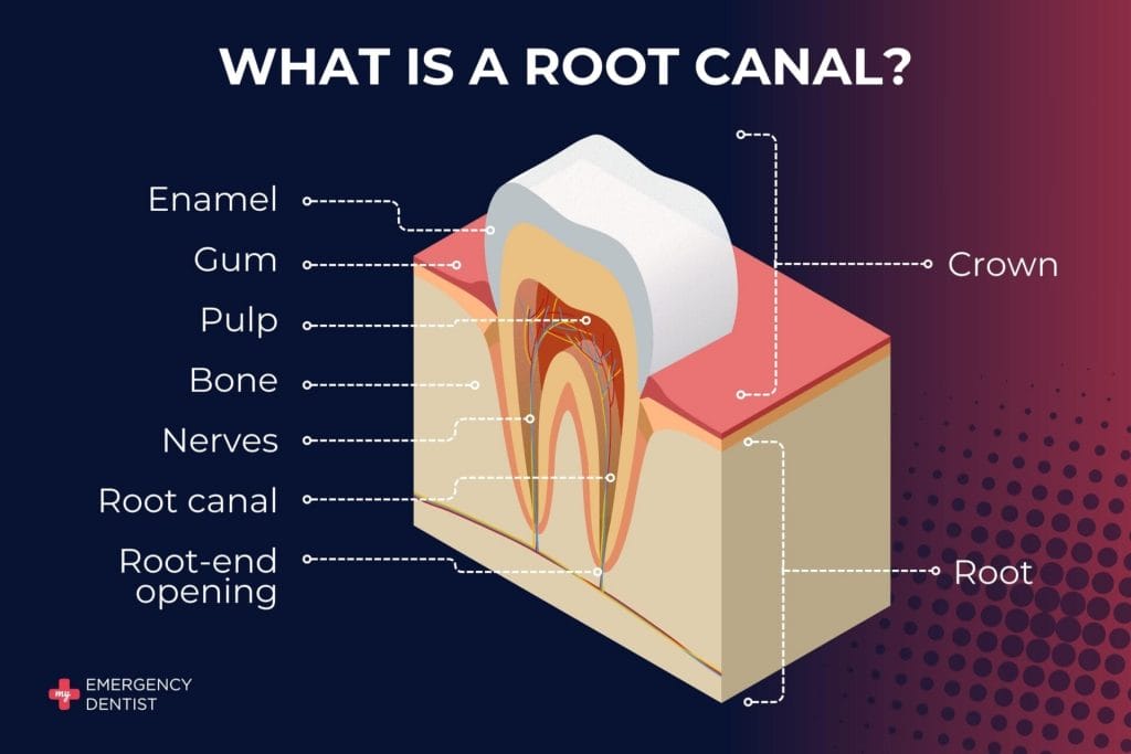 What is a root canal treatment